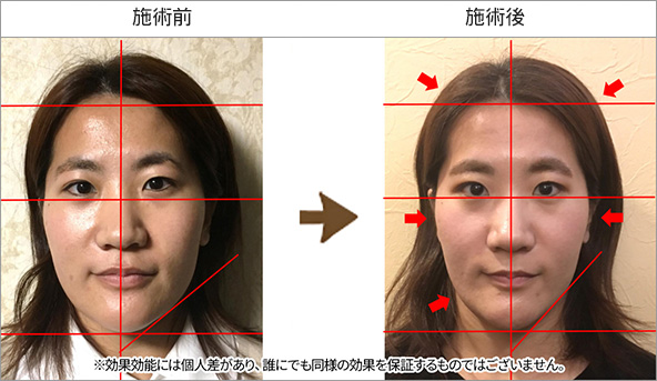 吉祥寺のリフトアップ特化型小顔 頭蓋骨矯正 アキュモ鍼灸整体院 Gp小顔整体